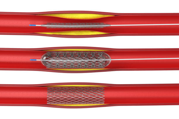 Coronary Angioplasty Treatment in Fortis Hospital Delhi