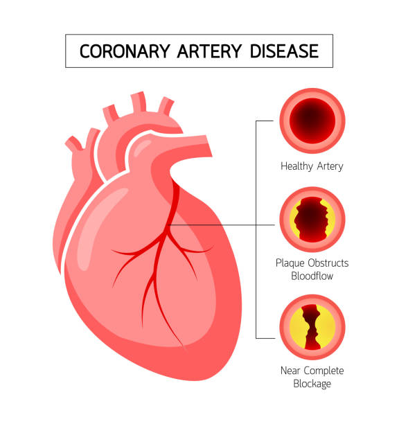 coronary artery disease treatment in shalimar bagh