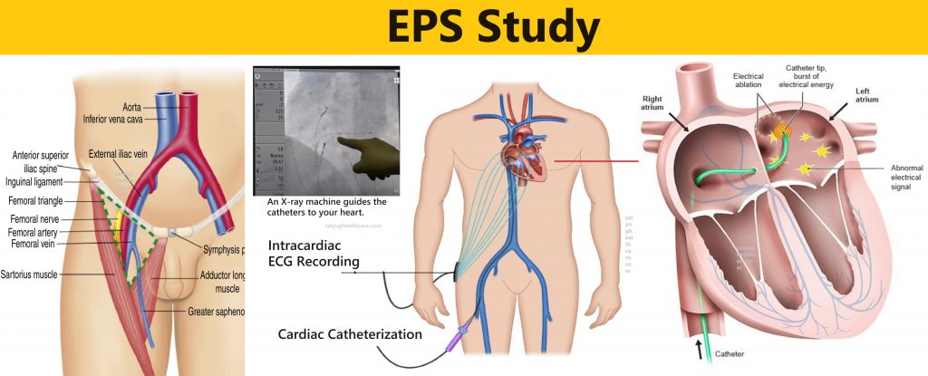 Electrophysiology Study: A Deep Dive into Your Heart’s Electrical System